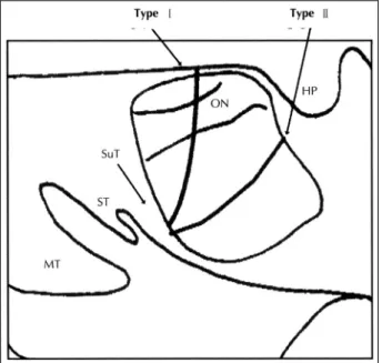 Fig. 5. Direction of the approach to the septum between the posterior ethmoid cell and the sphenoid sinus