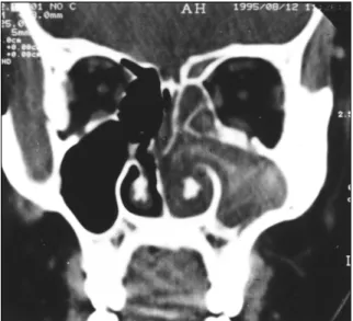 Fig. 1. A coronal CT scan of patient 1 showing a soft-tissue mass  occupying the left nasal cavity, maxillary, anterior ethmoid