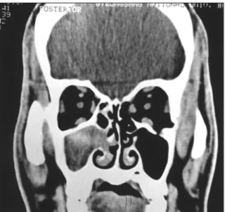 Fig. 3. A coronal CT of patient 2 showing opacity in the right maxillary and anterior ethmoid sinus