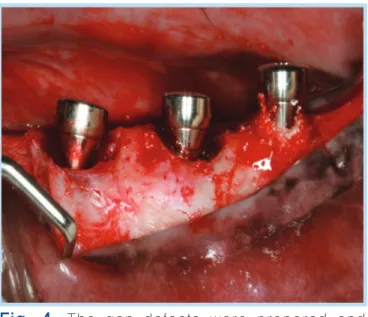 Fig. 4.  The  gap  defects  were  prepared  and Emdogain Ⓡ &amp; Cerasorb Ⓡ was grafted.