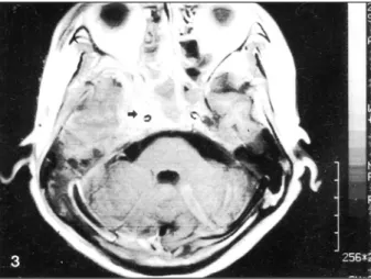 Fig. 4. Intermediate and squamous tumor cells and glands lined with mucous cell (H &amp; E stain, 200)