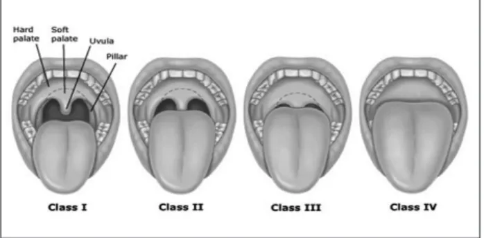Figure 1.   The modified Mallampati classification for  difficult laryngoscopy and intubation