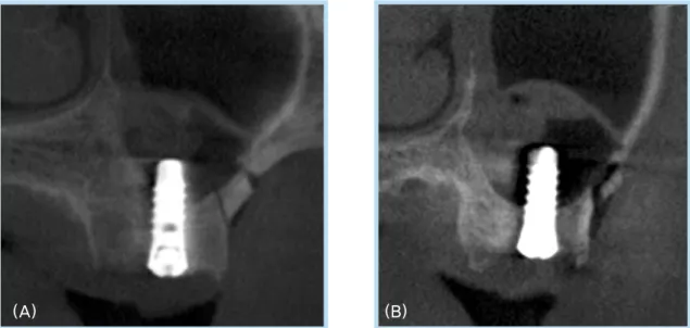 Fig 4.  (A, B) Patient 6의 상악 우측 제2대구치 부위(A)와 제1대구치 부위(B)에 각각 임프란트를 식립 직후 촬영한 Dental cone-beam CT scan으로 거상된 상악동막 하부에는 부분적으로 채워진 혈액과 공기로 채워져 있다