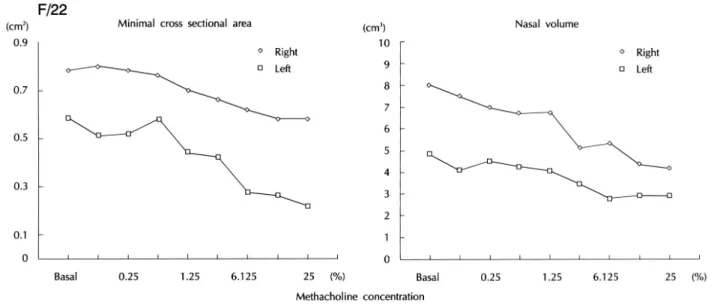 Fig. 2. Changes in minimal cross sectional (MCA) area and nasal volume (NV) in subject showing bilaterally negative response
