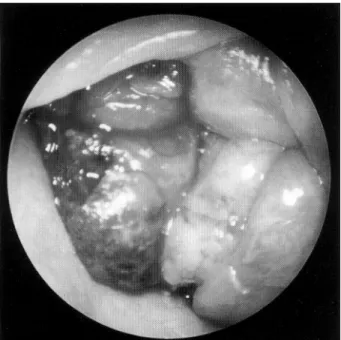 Fig. 1. Preoperative endoscopic finding showing smooth surfa- surfa-ced, polypoid mass filling the left nasal cavity