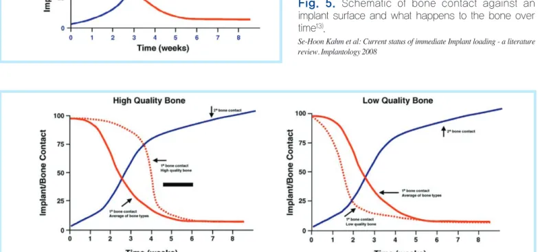 Fig. 5.  Schematic of bone contact against an implant surface and what happens to the bone over time 13) .