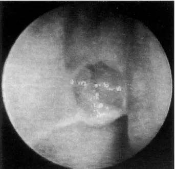Fig. 1. Preoperative endoscopic finding showing inflammatory polypoid masses in the middle meatus