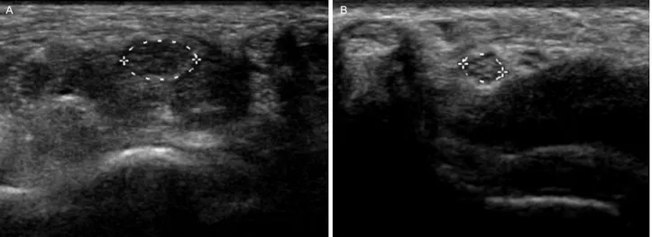 Figure 1. Median nerve ultrasonography in patients who showed negative routine nerve conduction study and median-to-ulnar compar- compar-ison test