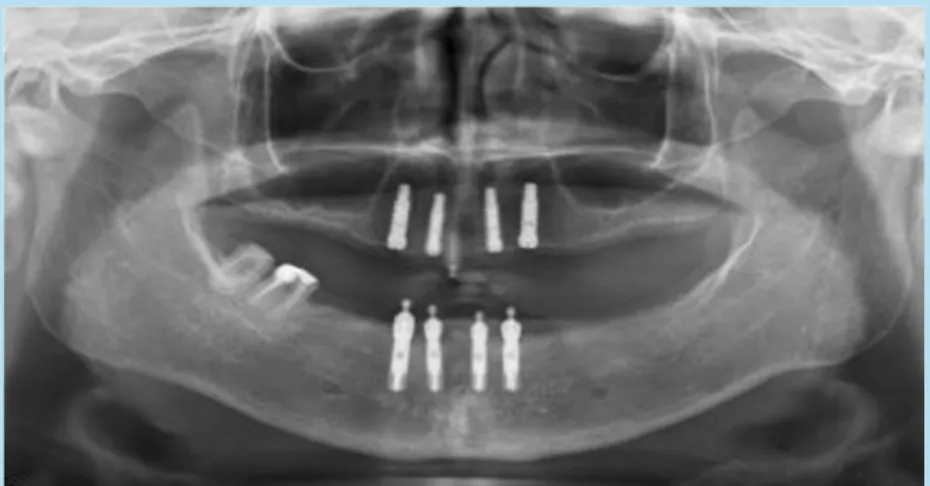 Fig. 2.  상악의 추가적인 implants 식립