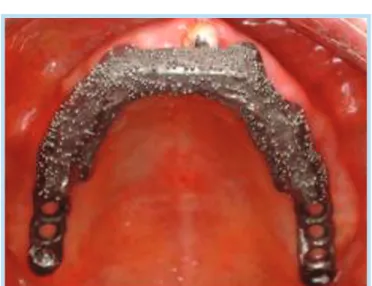Fig. 6.  완성된 상악 Milling  Bar  Type  Implant Supported Overdenture 모습