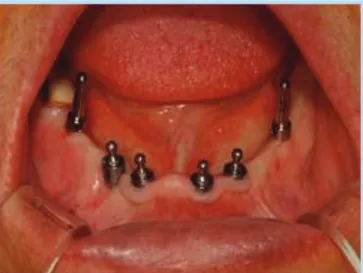 Fig. 9.  Denture relining Fig. 10.  구강내 시적한 모습