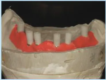 Fig. 11.  Individual Tray를 이용한 Pick up Impression  Fig. 12.  Casting  Abutment를 이용하여 Milling  된 내관 을 제작