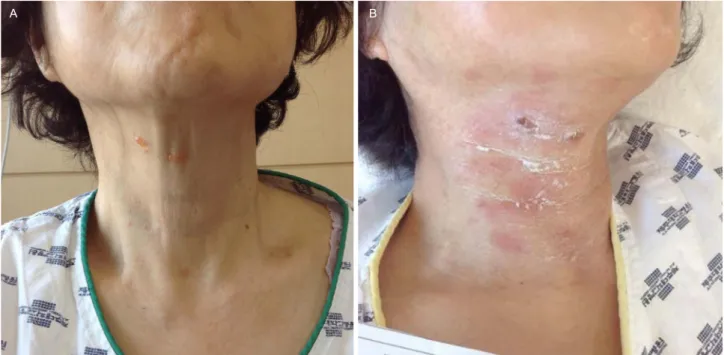 Figure 1. Skin lesions involving C3 dermatome on the right side, (A) bullae form at the second day of hospitalization, and (B) crusts at the  fifth day