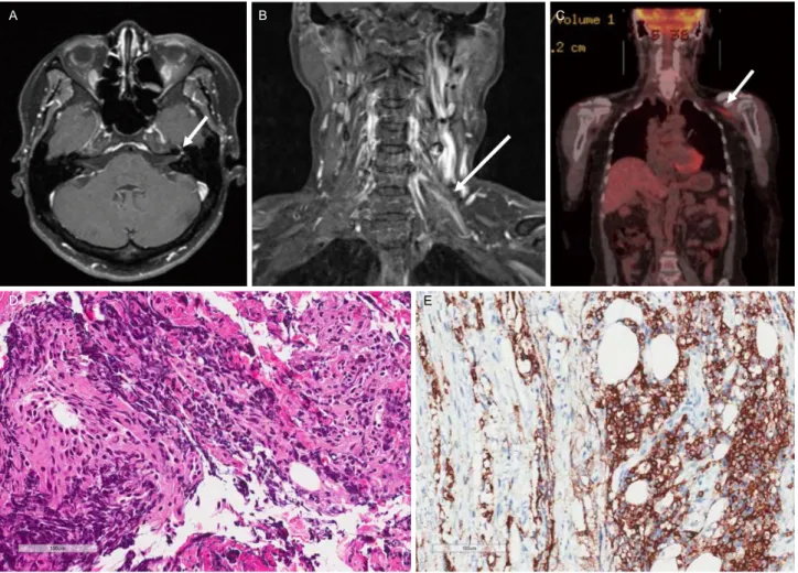 Figure 1. A 59-year-old female diagnosed with diffuse large-B-cell lymphoma which presented itself sequentially as diplopia, facial palsy, and  brachial