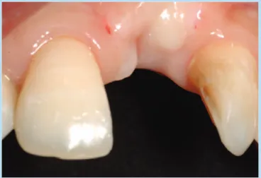 Fig. 34.  2nd surgery; preoperative view