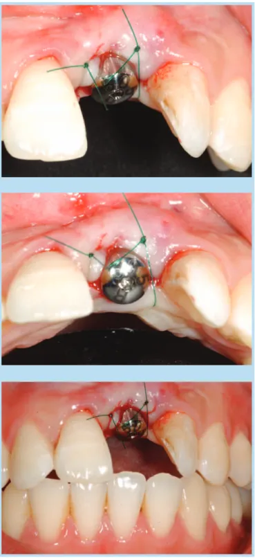 Fig. 35.  2nd surgery; postoperative view