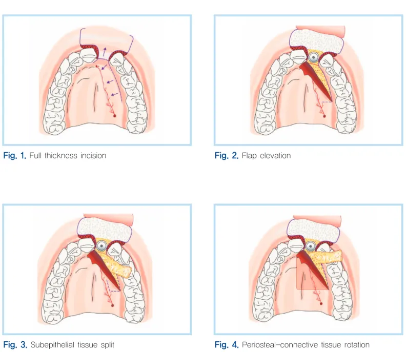 Fig. 1.  Full thickness incision Fig. 2.  Flap elevation