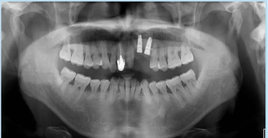 Fig. 8.  Preoperative intraoral view  Fig. 9.  Incision &amp; full thickness flap elevation