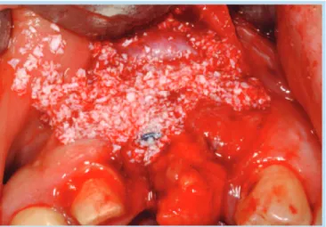 Fig. 12.  Recipient site coverage check Fig. 13.  Bone graft with Bio-oss 