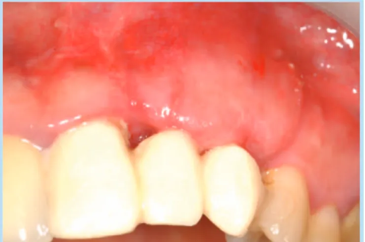 Fig. 20.  Healing abutment application Fig. 21.  Hypertrophic buccal gingiva