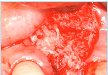 Fig. 31.  2 weeks after operationFig. 29.  Bone graft with Tutoplast �
