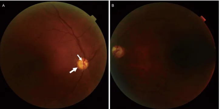 Figure 1. Fundus photographs of the patient. (A) Right eye of the patient. Optic nerve was very small with double ring sign consistent with  optic nerve hypoplasia