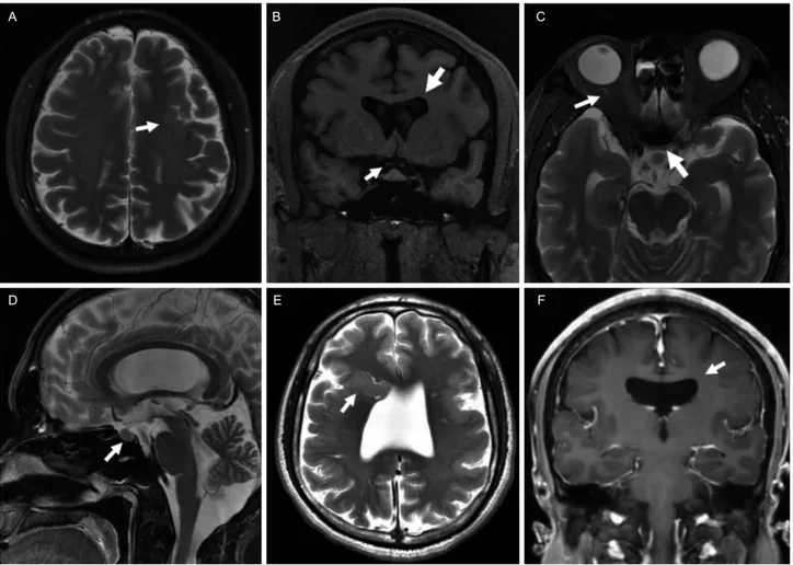 Figure 2. Brain magnetic resonance imaging of the patient (A-D) and his younger brother (E, F)
