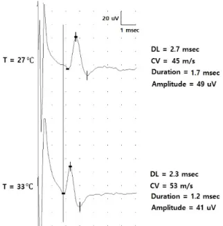 Figure 1. Temperature effect on nerve conduction studies of  median nerve. Median antidromic sensory studies demonstrate  that with cooler limb temperature, distal latency (DL) and  conduction velocity (CV) slow, whereas duration and amplitude  increase