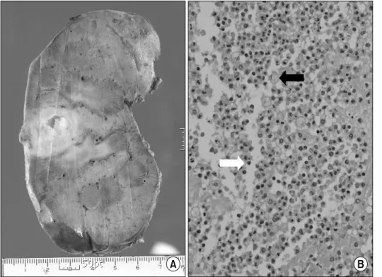 Fig.  3.  On  coronal  section,  middle  portion  of  kidney  shows  an  soft,  yellow  color  and  cavitary  lesion   respond-ing  to  the   xanthogranulo-matous  inflammation  (A)