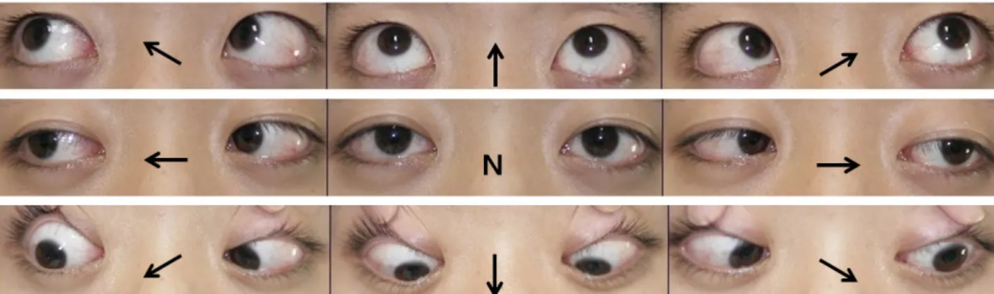 Figure 1.  Extraocular movements on admission. The patient shows limitations of abduction on horizontal gaze to the bilateral sides