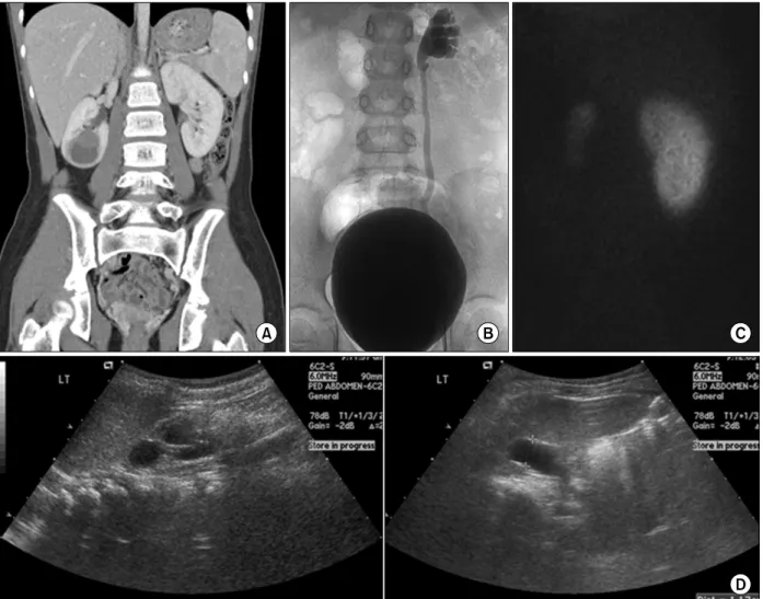 Fig.  2.  The  imaging  studies  of  case  1  (A),  2  (B,  C),  and  3  (D).  (A)  Contrast  enhanced  computed  tomography  shows  3.1  cm  sized  right  renal  cystic  mass  with  lobulating  contour