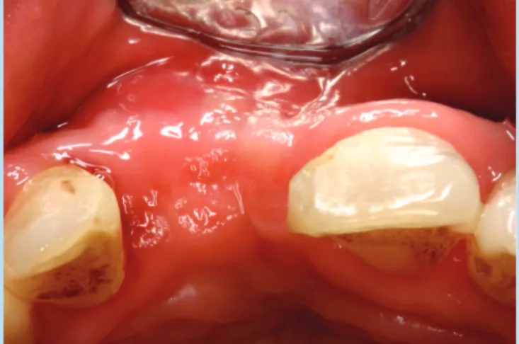 Fig. 18.  임프란트 식립 후 봉합사진(정면)