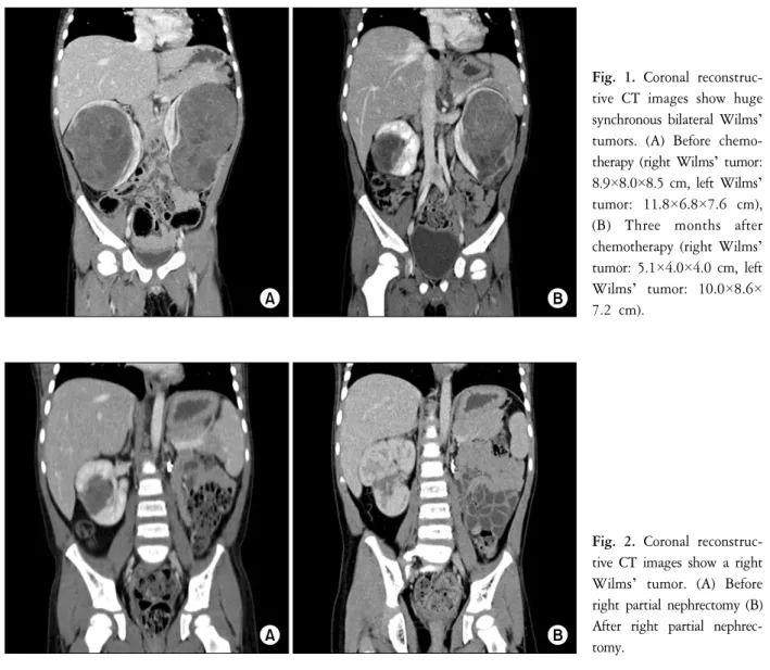 Fig.  1.  Coronal  reconstruc- reconstruc-tive  CT  images  show  huge  synchronous  bilateral  Wilms’ 