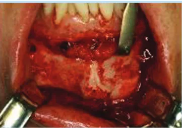 Fig.  6-4.  Postoperative  panoramic view  showing  the  good  healing process  of  recipient  site  and  donor site after metal removal