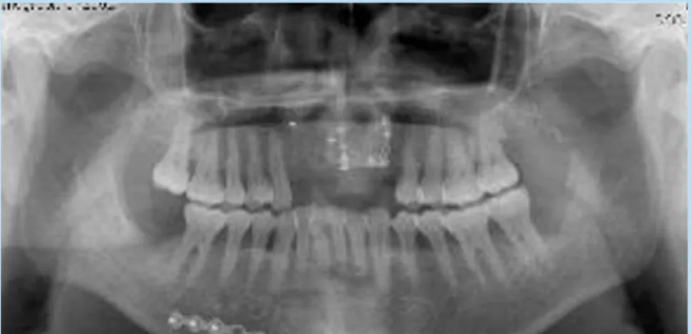 Fig.  5-4.  Panoramic  view  showing the  symphyseal  bone  grafted  to  the recipient  site  of  maxilla  anterior  and the donor site which is fixed miniplate and screws after Lubboc filling