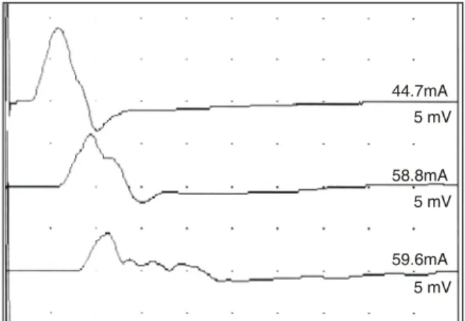Figure 2. Motor conduction block and abnormal temporal  dispersion with preserved conduction velocity in left median  nerve from patient with positive IgG anti-GalNAc-GD1a antibody  (Kim et al, unpublished data)