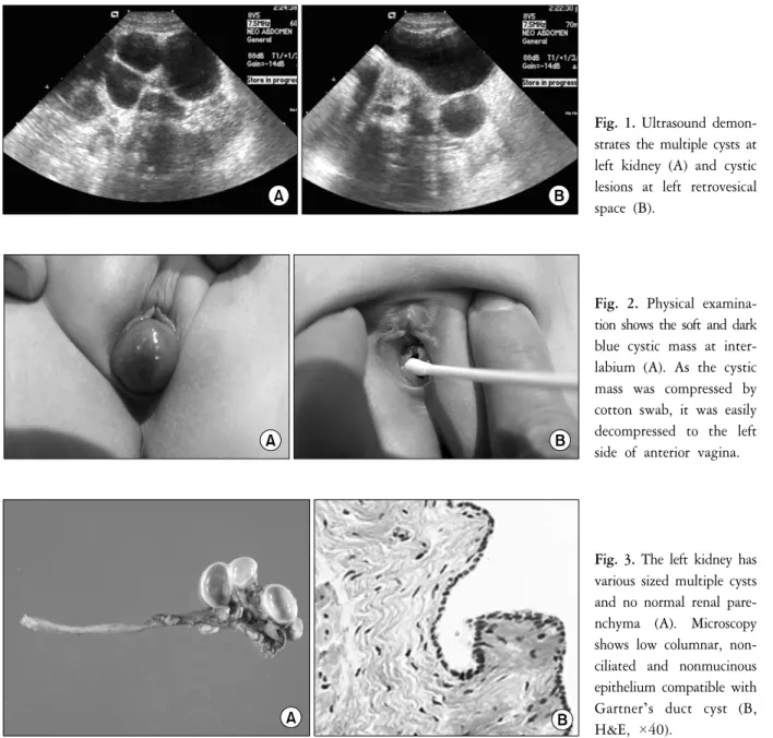 Fig.  1.  Ultrasound  demon- demon-strates  the  multiple  cysts  at  left  kidney  (A)  and  cystic  lesions  at  left  retrovesical  space  (B).