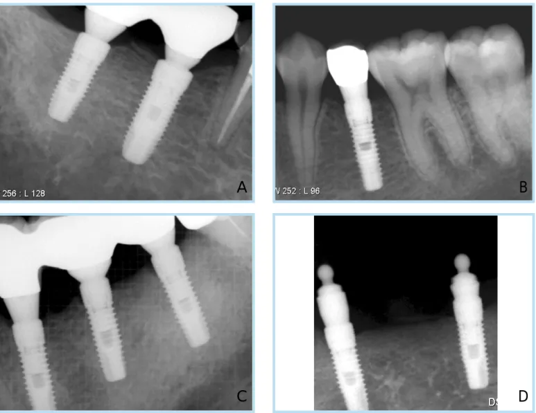 Fig. 4.  Crestal bone response in several cases after 1 year of loading. A, very favorable response