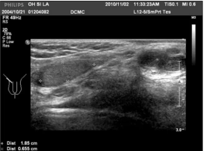 Fig.  1.  Preoperative  ultrasonography  shows  small  testis  and  hernia  in  left  inguinal  area.