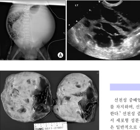 Fig.  1.  Preoperative  abdomen  plain  X  ray  and   ultrasono-graphy.  (A)  Huge  soft  tissue  opacity  in  mid  and  left  abdomen