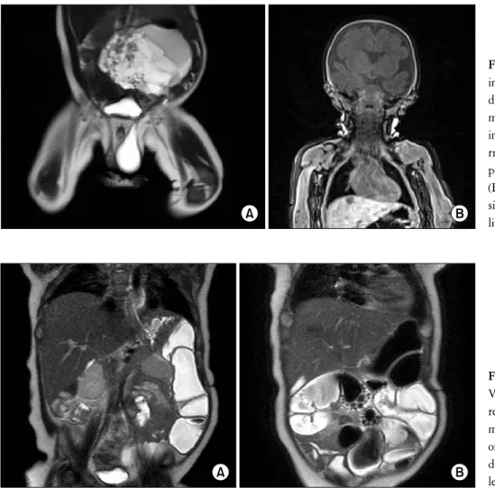 Fig.  3.  Non  contrast  MRI  images  show  local  and  distant  recurrence.  (A)  Huge  mainly  cystic  mass  with  internal  septation  and   hemo-rrhage  is  seen  in  the   retro-peritoneum  of  left  abdomen