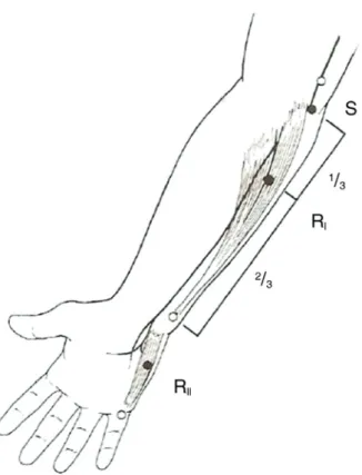 Figure 3. Oh’s method of RNST on the flexor carpi ulnaris (R I )  and abductor digiti quinti (R II )