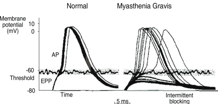 Figure 4. A schematic explanation of jitter in both a normal and myasthenic NMJ. A. A normal NMJ demonstrates a small amount  (<50  μs) of variability in achieving threshold from one depolarization to the next
