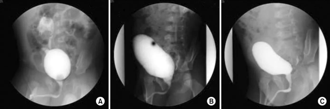 Fig.  1.  Serial  voiding  cystourethrographys  performed  at  2  months  (A),  36  months  (B)  and  45  months  (5  months  after  treatment)  (C)
