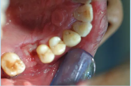 Fig. 1.  The finding of post-operative 10 days: The extraction site was effectively covered by palatal rotation flap.