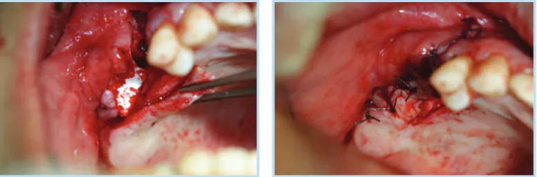 Fig. 2.  The palatal rotation flap was designed and applied for covering exposed bio-membrane.