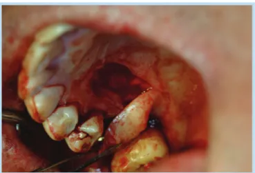 Fig. 6.  Rotation of palatal rotation flap: Careful manipulation is necessary for preventing kinking or dog-ear.