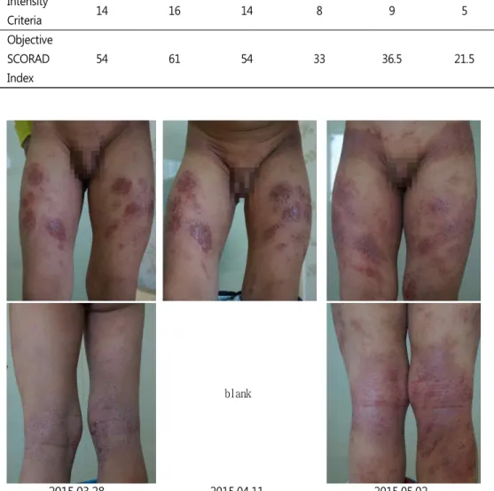 Table  3. Clinical  Progress of  Objective  SCORAD Index