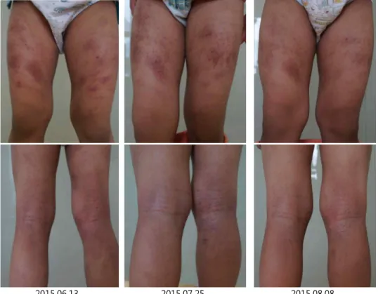 Fig.  2. Pictures  of Atopic  Dermatitis lesions