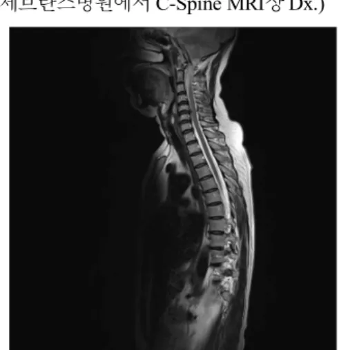 Fig.  1  C-Spine  MRI  :  HIVD  of  C4,5,6,7